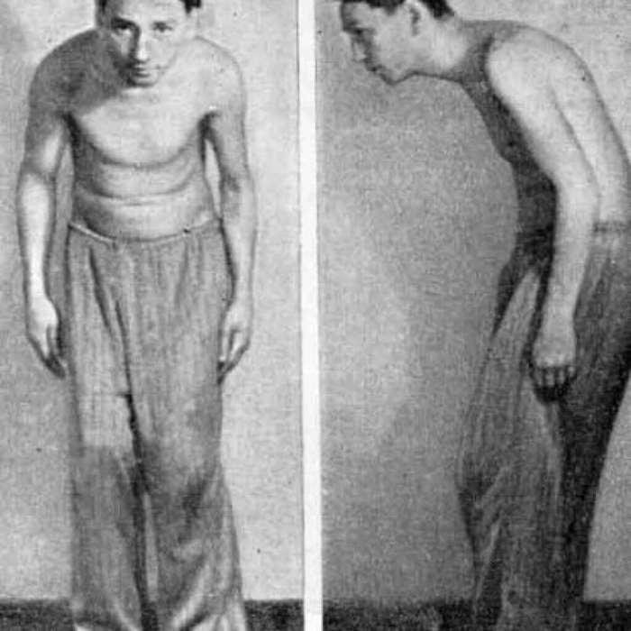 Человек с анкилозирующим спондилоартритом